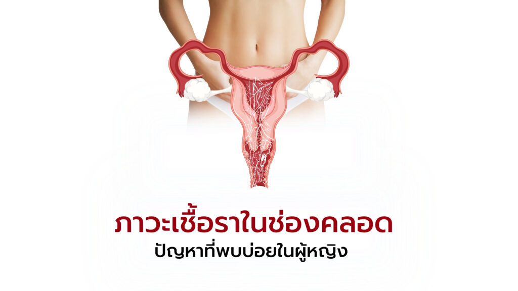 เชื้อราช่องคลอด